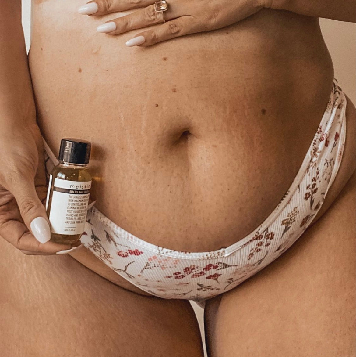 Postpartum mother applying Meiskin stretch mark and scar treatment oil to belly
